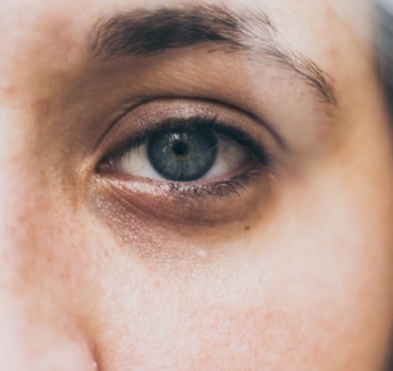 What Causes Dark Circles Under Your Eyes Optical Express
