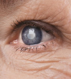 closeup of eye with cataract